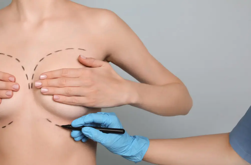 3D Endoscopic LakoBar breast augmentation procedure with implant and fat grafting in Korea