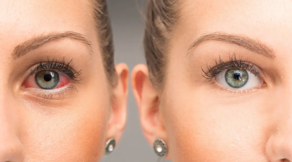 Dry Eye Syndrome Treatment in Gangnam Seoul Korea using meibomian gland imaging and IPL therapy