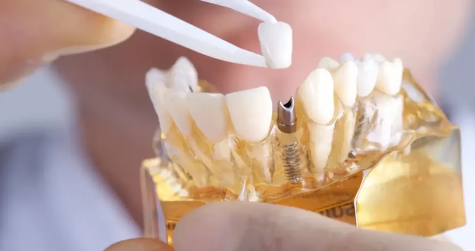 3D guided dental implants for foreigners in Korea with digital implant surgery planning