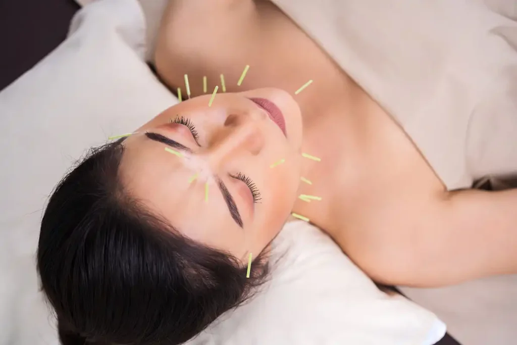 Herbal Extract Acupuncture in Korea for foreigners, showing needle therapy with herbal injections in a clinical setting