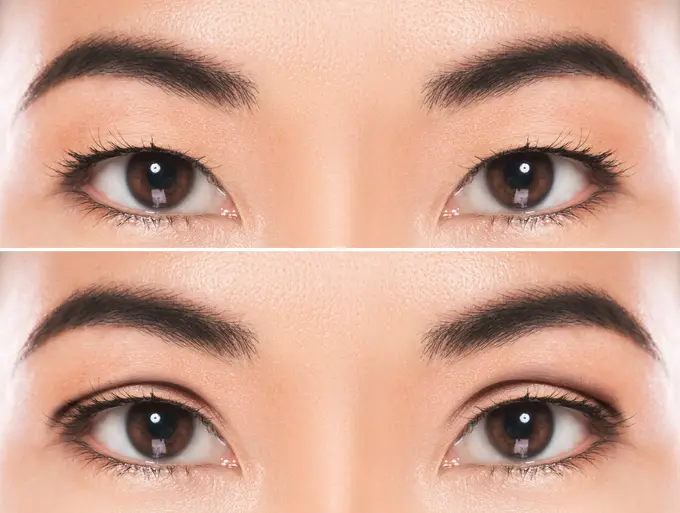 Comparison diagram of non-incisional vs incisional double eyelid surgery in Korea for foreign patients