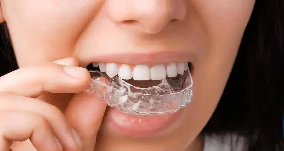 Short-term orthodontic treatment for foreigners in Korea using clear aligners and digital 3D smile simulation